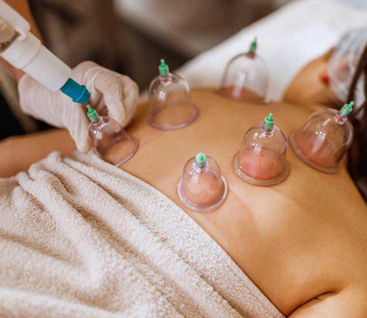 Cupping Massage